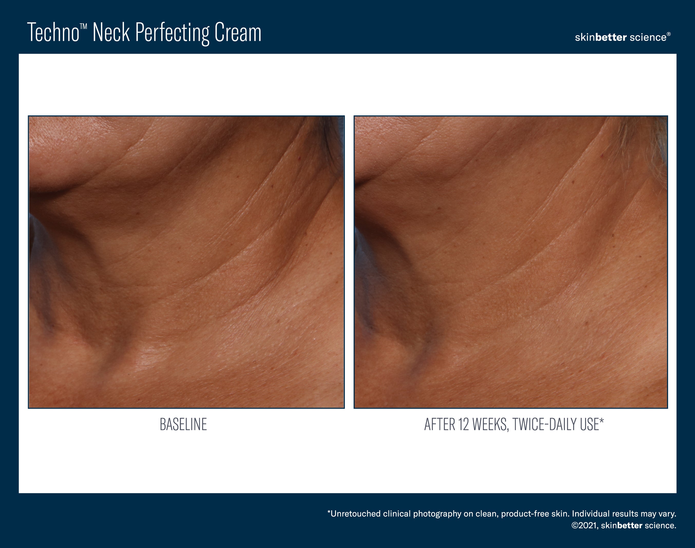 Skinbetter Science Techno neck perfecting cream - www.Hudonline.no 