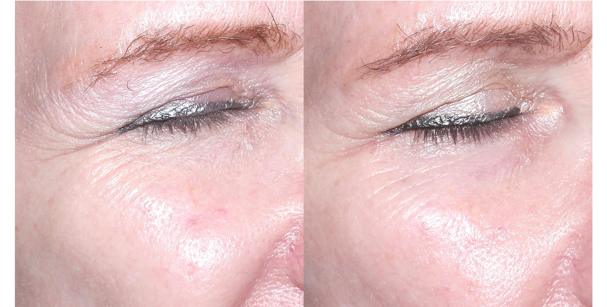 North Cosmedic All Trans Retinol 0,5% - www.Hudonline.no
