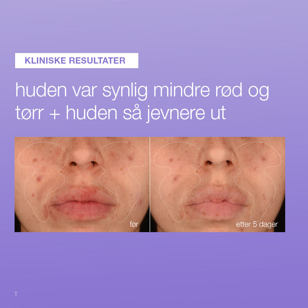 Dermalogica Stabilizing Repair Serum før og etter 5 dager – synlig mindre rødhet og tørrhet i ansiktet