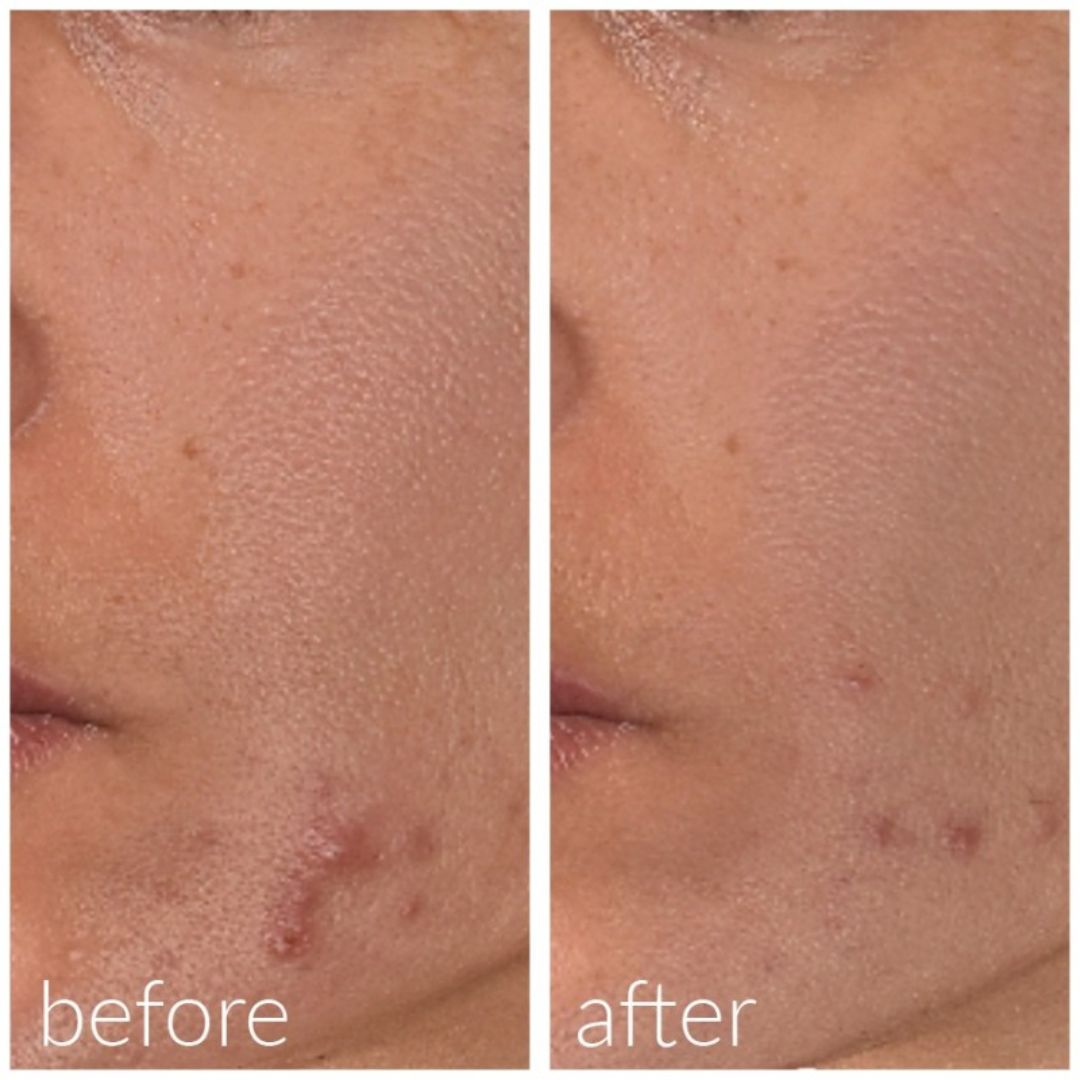 Md Skin Solutions Meso´Me Clear 20 ml - www.Hudonline.no 