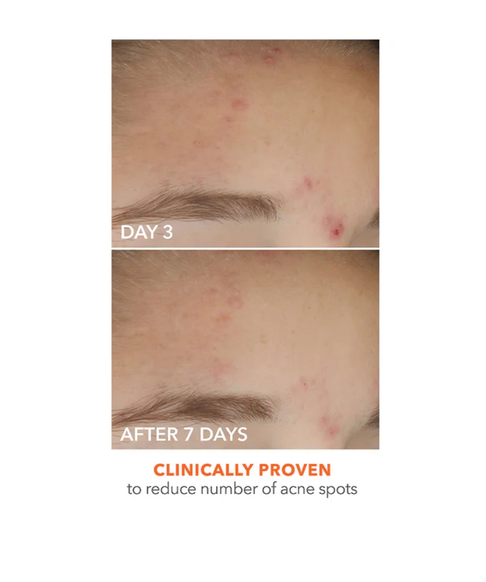 Dr Dennis Gross Alpha Beta Acne Solution Sett - www.Hudonline.no