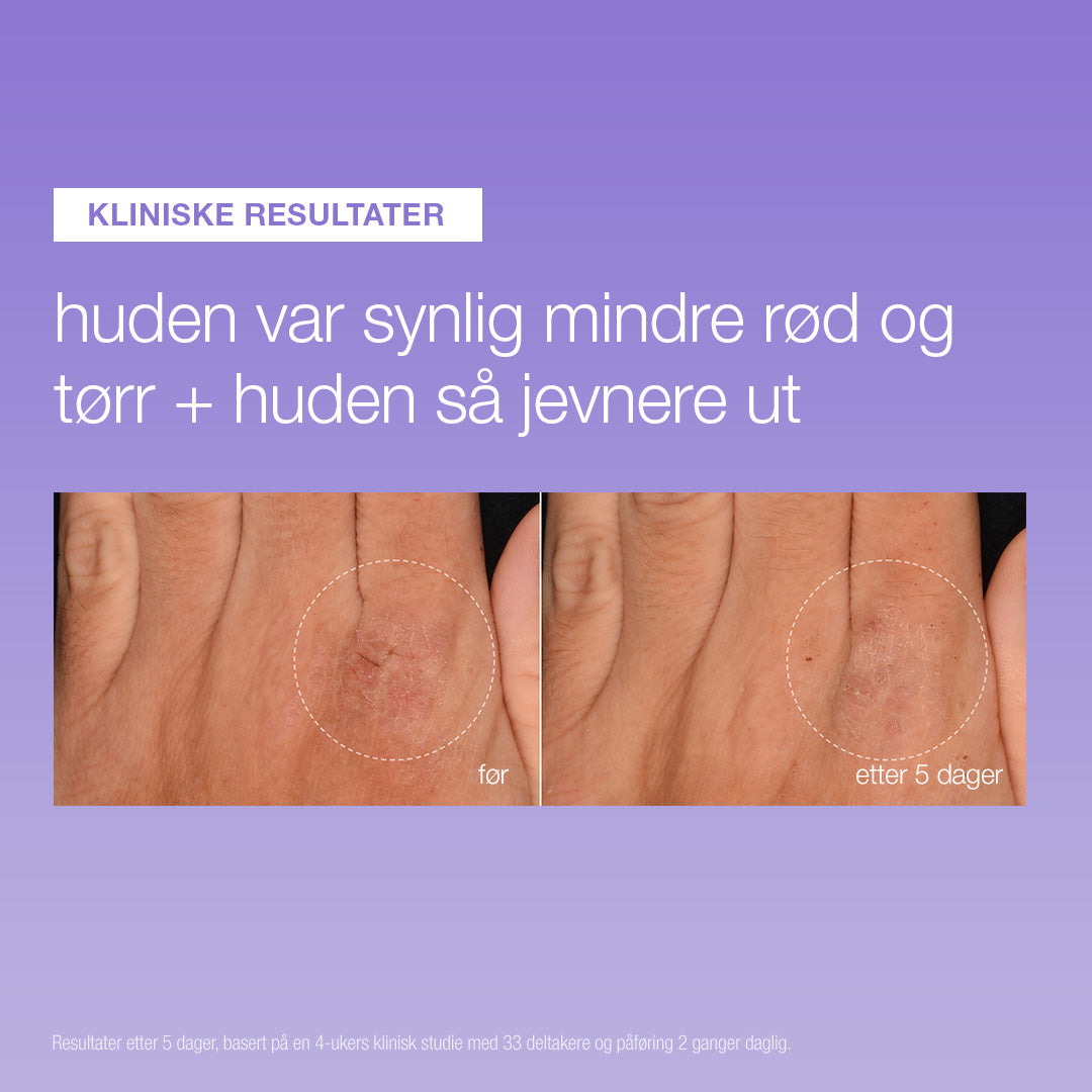 Dermalogica Stabilizing Repair Serum før og etter 5 dager – mindre tørr og rød hud på hånden