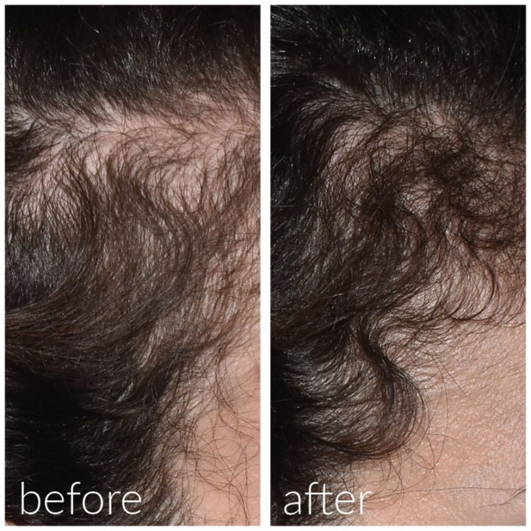 Md Skin Solutions Meso´Me Hair 20 ml - www.Hudonline.no 