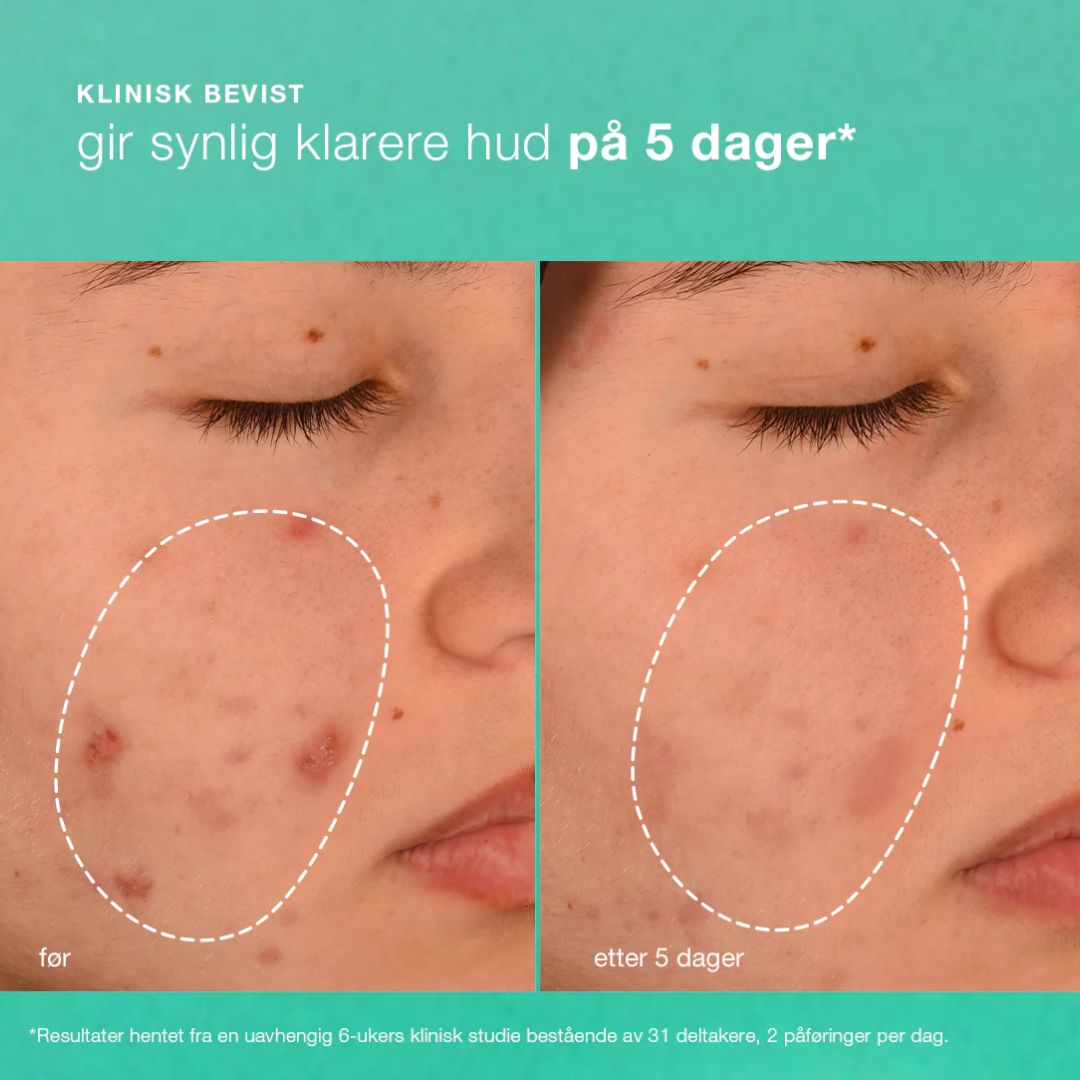 Dermalogica Breakout Biotic Moisturizer 50 ml - www.Hudonline.no 