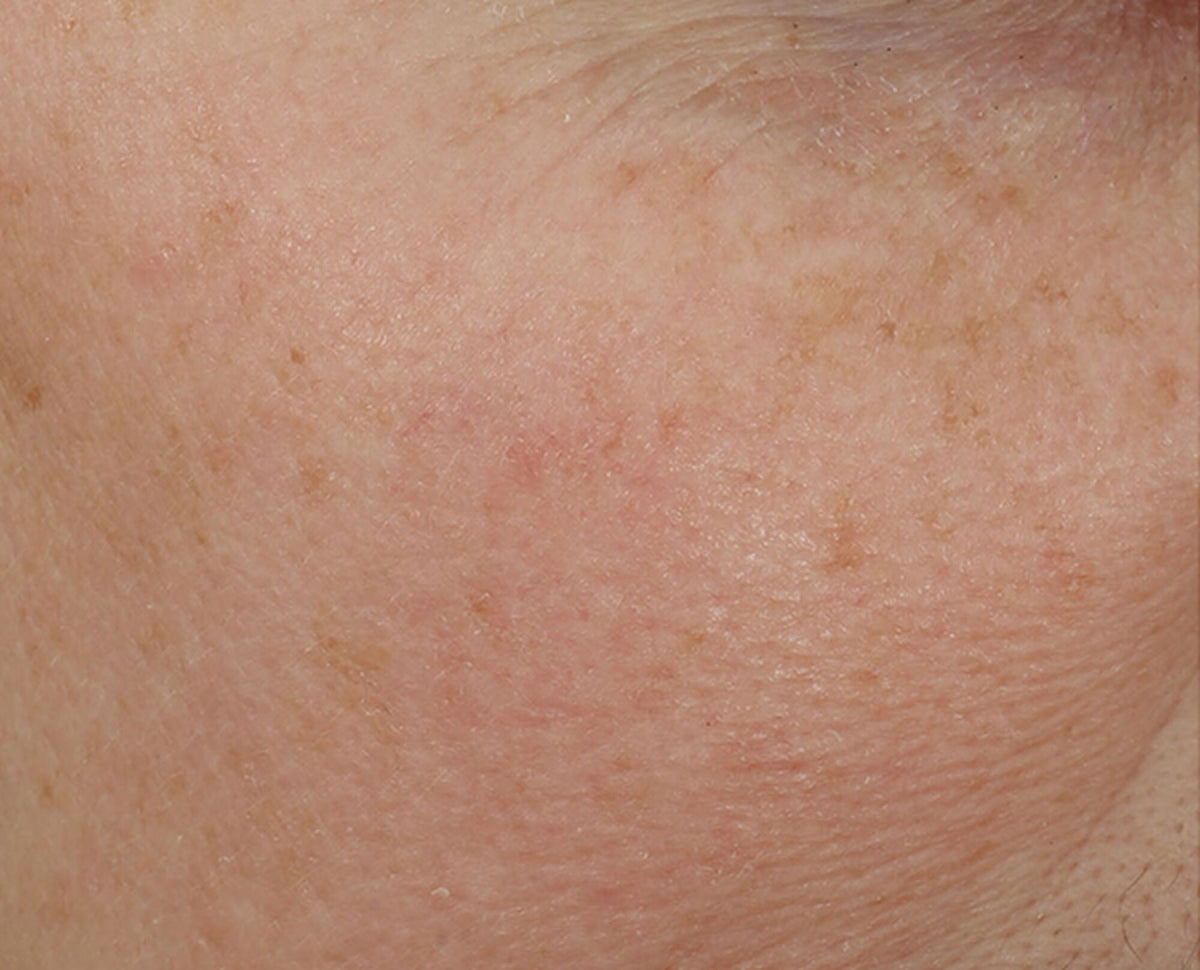 Dr Dennis Gross Overnight Wrinkle Treatment - etter behandling - www.Hudonline.no
