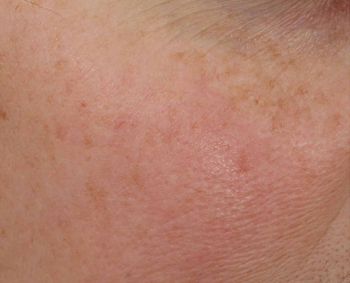 Dr Dennis Gross Overnight Wrinkle Treatment - for behandling - www.Hudonline.no