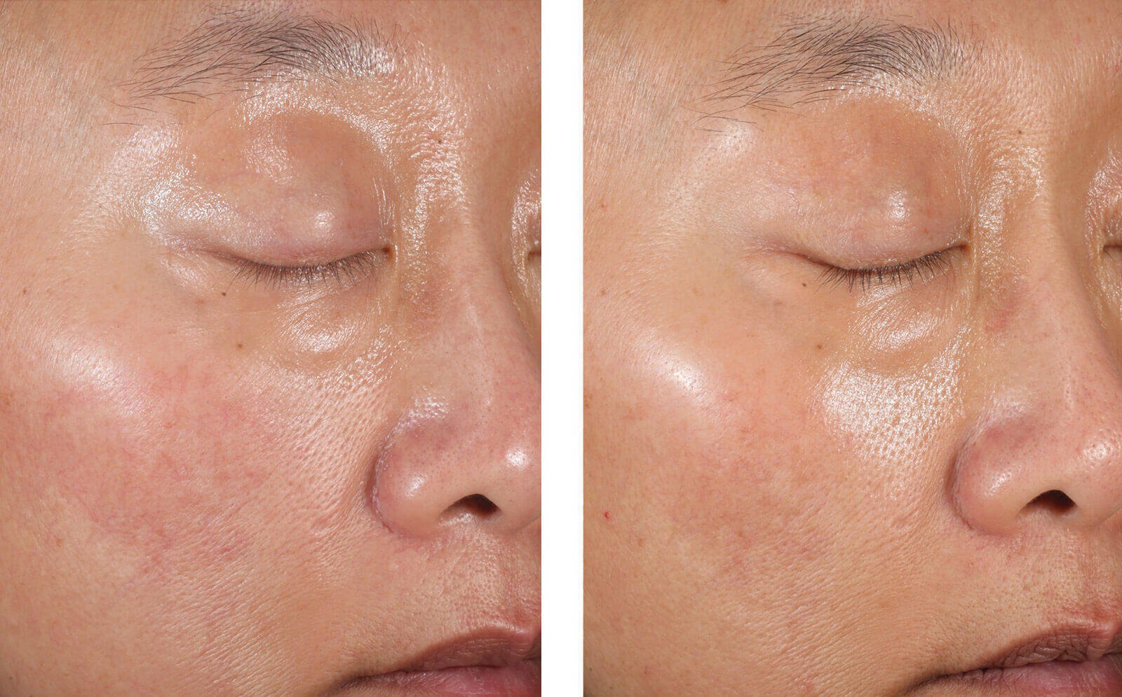 Skinbetter Science A-Team Duo Kit Advanced - www.Hudonline.no 