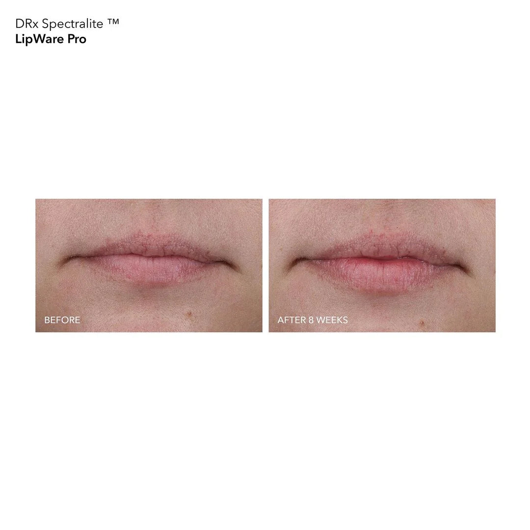 Dr Dennis Gross DRx SpectraLite LipWare Pro - www.Hudonline.no 