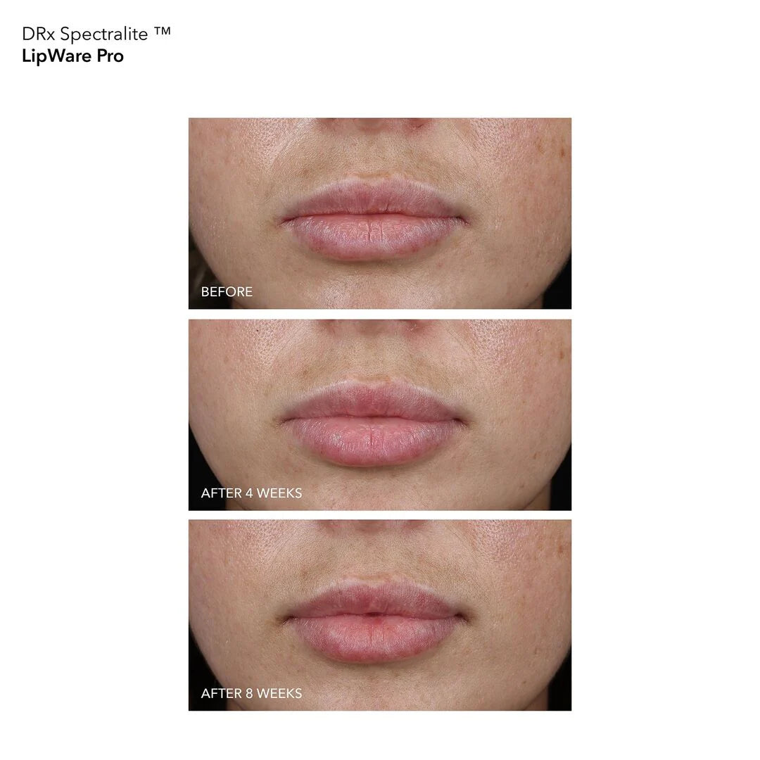 Dr Dennis Gross DRx SpectraLite LipWare Pro - www.Hudonline.no 
