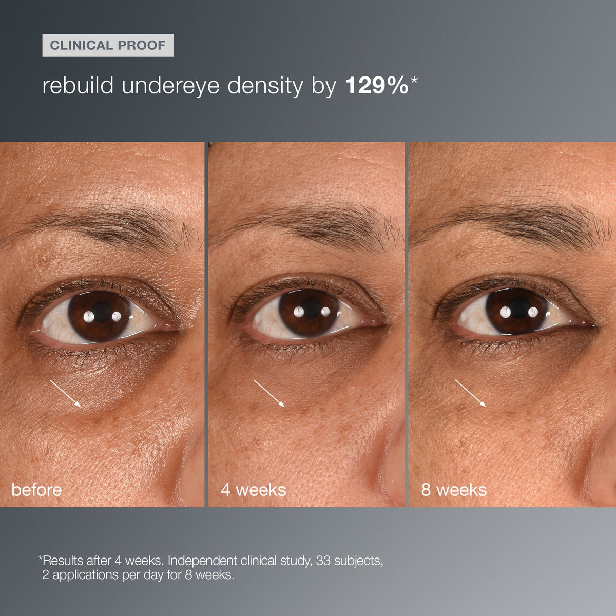 Smart Eye Density – klinisk før/etter 1