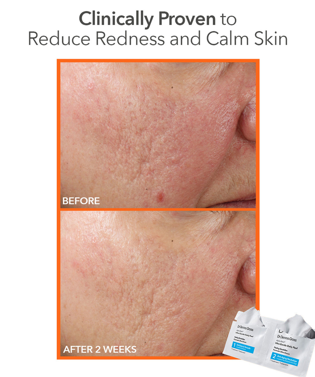 Dr Dennis Gross Alpha Beta Face Peel Ultra Gentle PeelPads - www.Hudonline.no