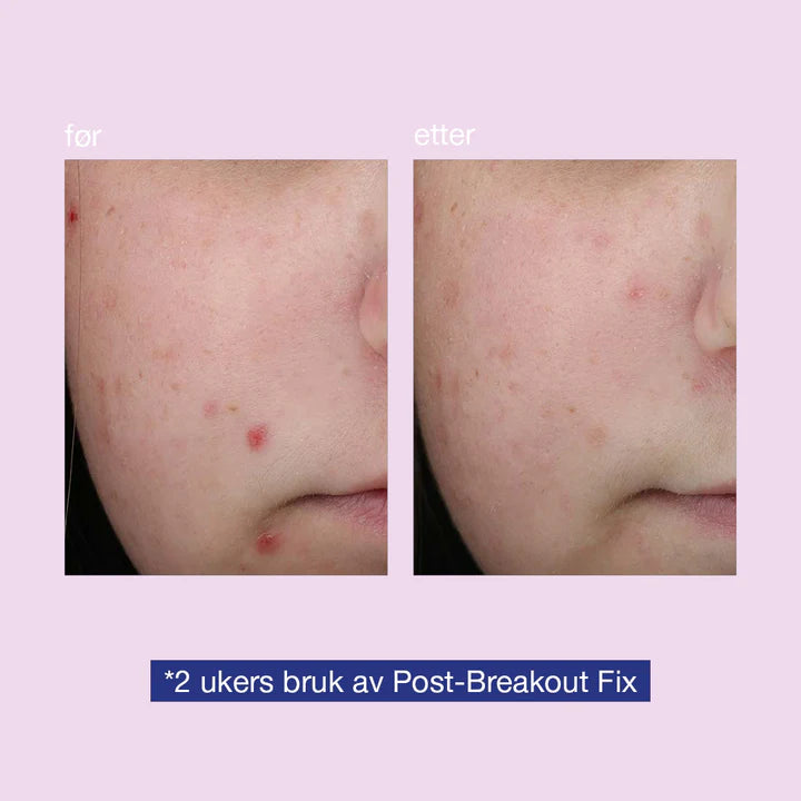 Dermalogica Post-Breakout Fix 15ml - www.Hudonline.no 